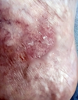 Bird Mites Rash On Humans